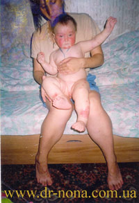 Дерматит атопический