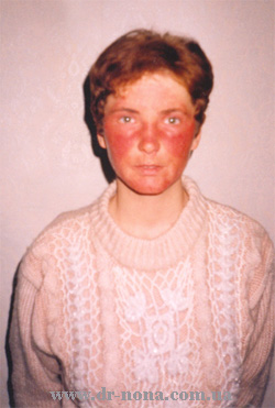 Лечение лицевого клеща