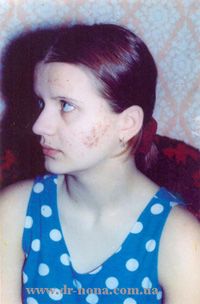 Подростковые вульгарные угри